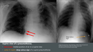 • Supine view of a pneumothorax.
• Red arrows: medial position of air in a supine view
• Letter D (right): deep sulcus sign of a supine pneumothorax
Image borrowed from: Chest Radiology. (2018). Med-ed.virginia.edu.
Retrieved 24 September 2018, from https://www.med-
ed.virginia.edu/courses/rad/cxr/pathology8
Deep Sulcus
Sign
 