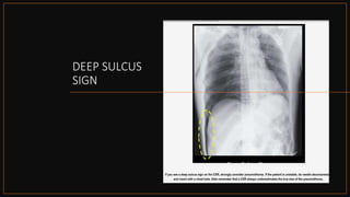 Pneumothorax | PPTX