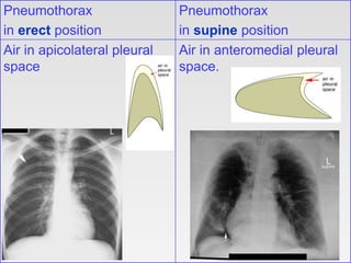 Pneumothorax
in erect position
Pneumothorax
in supine position
Air in apicolateral pleural
space
Air in anteromedial pleural
space.
 