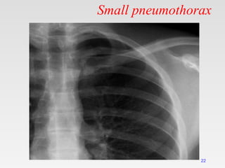 Small pneumothorax
22
 