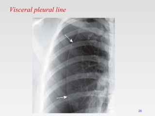 Visceral pleural line
26
 