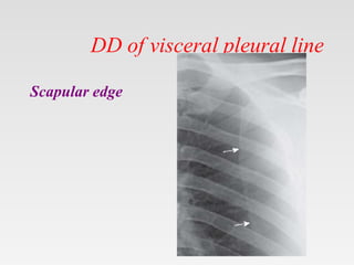 DD of visceral pleural line
Scapular edge
 