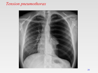 Tension pneumothorax
29
 