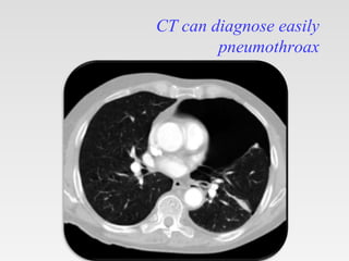 CT can diagnose easily
pneumothroax
 
