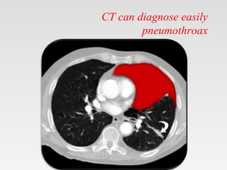 CT can diagnose easily
pneumothroax
 