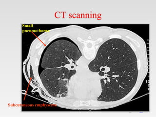 35
35
CT scanning
Small
pneumothorax
Subcutaneous emphysema
 