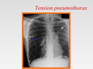 Tension pneumothorax
 