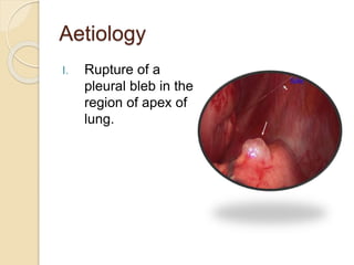 Aetiology
I. Rupture of a
pleural bleb in the
region of apex of
lung.
 