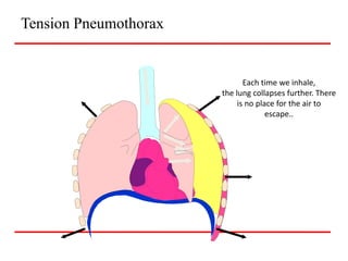 Tension Pneumothorax
Each time we inhale,
the lung collapses further. There
is no place for the air to
escape..
 
