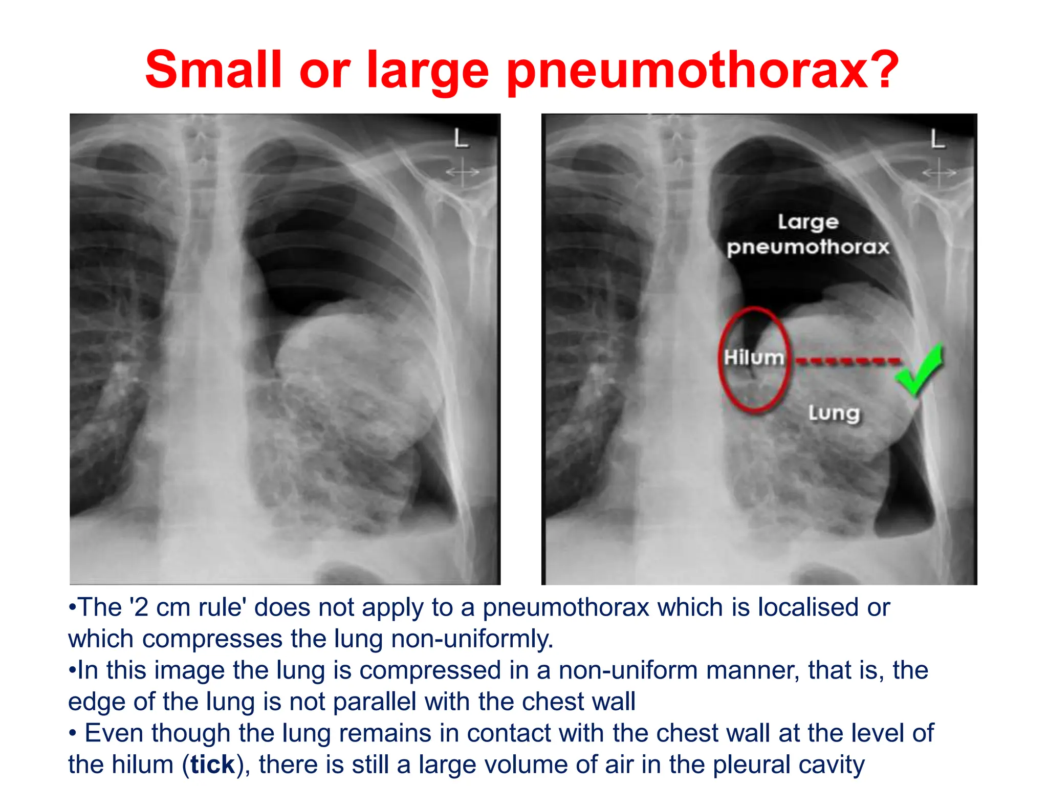 PNEUMOTHORAX IN CHEST XRAY INTERPRETATIONpptx PPTX