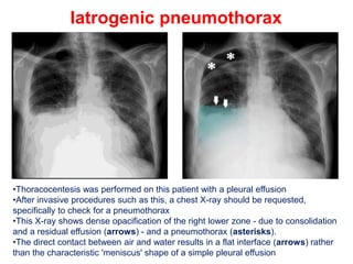 PNEUMOTHORAX IN CHEST XRAY INTERPRETATIONpptx PPTX pneumothorax-in-chest-xray-interpretationpptx-pptx