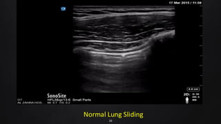 Normal Lung Sliding
26
 