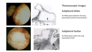Thoracoscopic images 
Subpleural blebs 
Air filled spaces between the lung 
parenchyma and the visceral pleura 
Subpleural bullae 
Air filled spaces within the lung 
parenchyma itself 
 