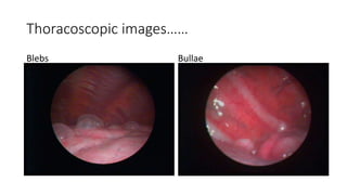 Thoracoscopic images…… 
Blebs Bullae 
 