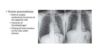 • Tension pneumothorax 
• Shift of mobile 
mediastinal structures to 
the opposite side 
• Inversion of 
hemidiaphragm 
• Flatting of heart contour 
on the side under 
tension. 
 