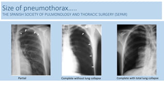 Size of pneumothorax….. 
THE SPANISH SOCIETY OF PULMONOLOGY AND THORACIC SURGERY (SEPAR) 
Partial Complete without lung collapse Complete with total lung collapse 
 
