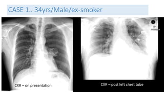 CASE 1.. 34yrs/Male/ex-smoker 
CXR – on presentation CXR – post left chest tube 
 