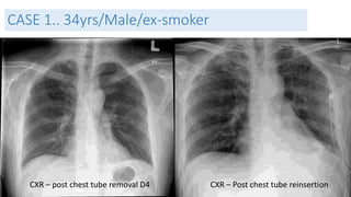 CASE 1.. 34yrs/Male/ex-smoker 
CXR – post chest tube removal D4 CXR – Post chest tube reinsertion 
 