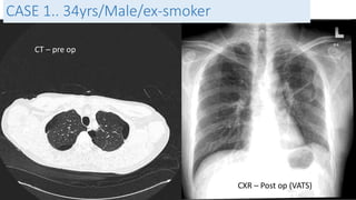 CXR – Post op (VATS) 
CASE 1.. 34yrs/Male/ex-smoker 
CT – pre op 
 