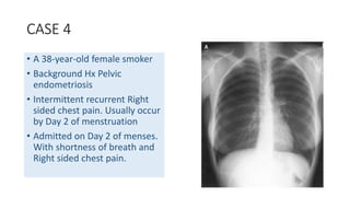 CASE 4 
• A 38-year-old female smoker 
• Background Hx Pelvic 
endometriosis 
• Intermittent recurrent Right 
sided chest pain. Usually occur 
by Day 2 of menstruation 
• Admitted on Day 2 of menses. 
With shortness of breath and 
Right sided chest pain. 
 