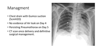 Managment 
• Chest drain with Gumco suction 
(5cmH2O) 
• No evidence of Air leak on Day 4 
• Persisting Pneumothorax on Day 5 
• CT scan once delivery and definitive 
surgical management. 
 