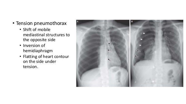Pneumothorax case based