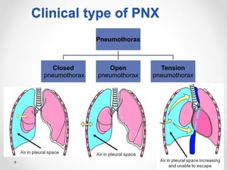 16
Clinical type of PNX
Pneumothorax
Closed
pneumothorax
Open
pneumothorax
Tension
pneumothorax
 