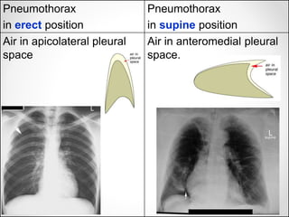 Pneumothorax
in erect position
Pneumothorax
in supine position
Air in apicolateral pleural
space
Air in anteromedial pleural
space.
 