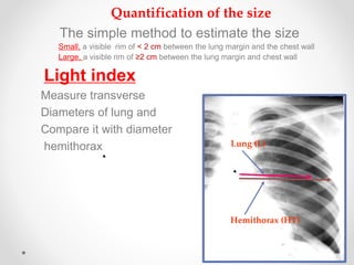 Quantification of the size
The simple method to estimate the size
Small, a visible rim of < 2 cm between the lung margin and the chest wall
Large, a visible rim of ≥2 cm between the lung margin and chest wall
Light index
Measure transverse
Diameters of lung and
Compare it with diameter
hemithorax
2525
Hemithorax (HT)
Lung (L)
 