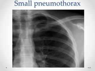 Small pneumothorax
29
 