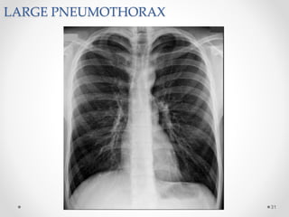 LARGE PNEUMOTHORAX
31
 