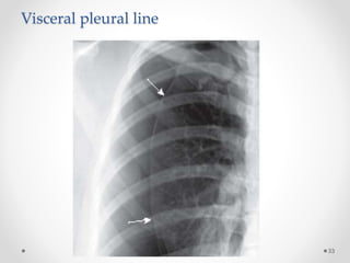 Visceral pleural line
33
 