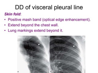 DD of visceral pleural line
Skin fold:
• Positive mash band (optical edge enhancement).
• Extend beyond the chest wall.
• Lung markings extend beyond it.
 