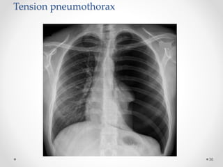 Tension pneumothorax
36
 