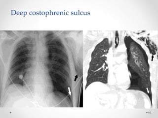 Deep costophrenic sulcus
40
 