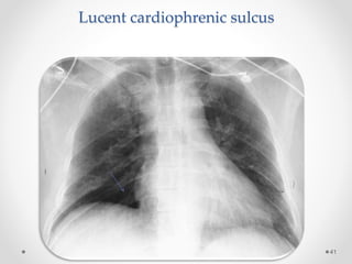 Lucent cardiophrenic sulcus
41
 