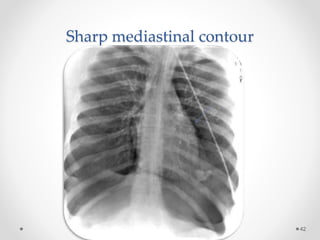 Sharp mediastinal contour
42
 