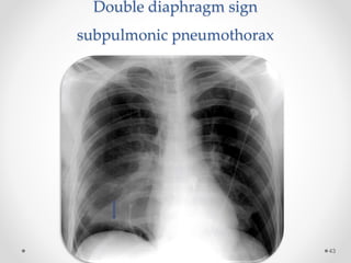 Double diaphragm sign
subpulmonic pneumothorax
43
 