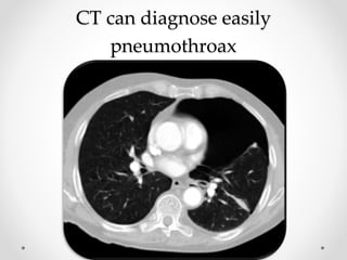 CT can diagnose easily
pneumothroax
 