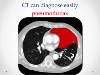 CT can diagnose easily
pneumothroax
 