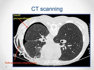 4848
CT scanning
Small
pneumothorax
Subcutaneous emphysema
 