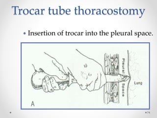 Trocar tube thoracostomy
74
 Insertion of trocar into the pleural space.
 