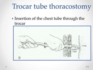 Trocar tube thoracostomy
75
 Insertion of the chest tube through the
trocar
 