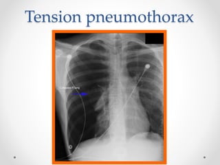Tension pneumothorax
 