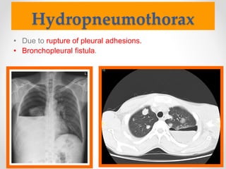 Hydropneumothorax
• Due to rupture of pleural adhesions.
• Bronchopleural fistula.
 