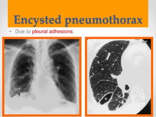 Encysted pneumothorax
• Due to pleural adhesions.
 