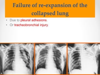 Failure of re-expansion of the
collapsed lung
• Due to pleural adhesions.
• Or tracheobronchial injury.
 