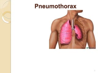 Pneumothorax
1
 