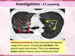 Pneumothorax and pneumomediastinum | PDF