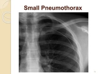 15
Small Pneumothorax
 